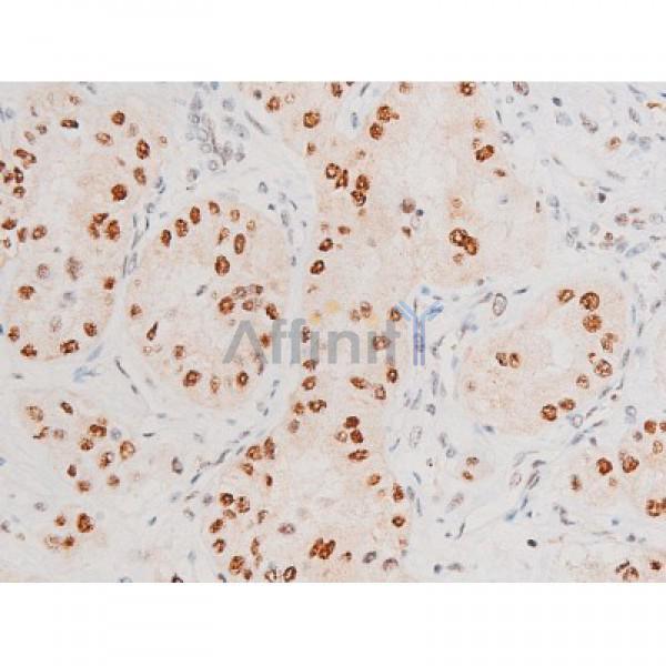 Phospho-JNK1/2/3 (Thr183+Tyr185) Antibody - AF3318 at 1/200 staining Human bladder cancer tissue sections by IHC-P.